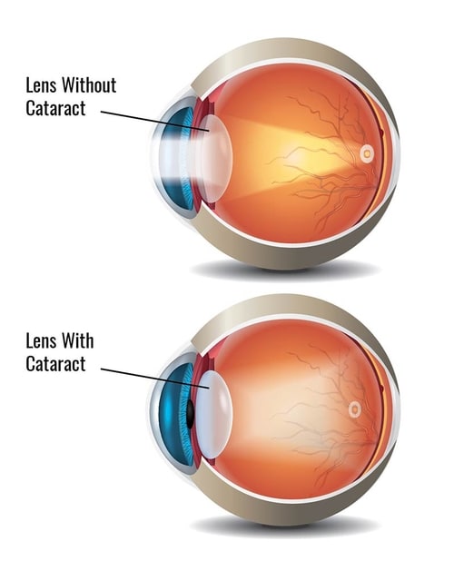 Cataract surgery lens diagram