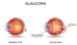 early signs of glaucoma