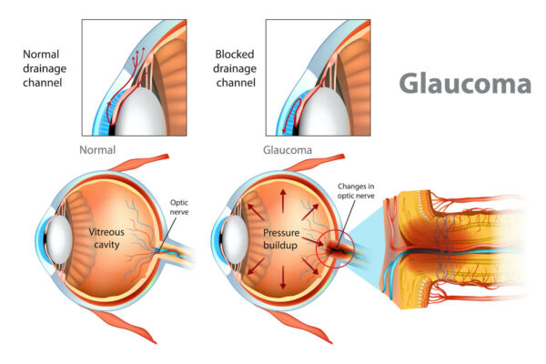 Diagram of cause of glaucoma