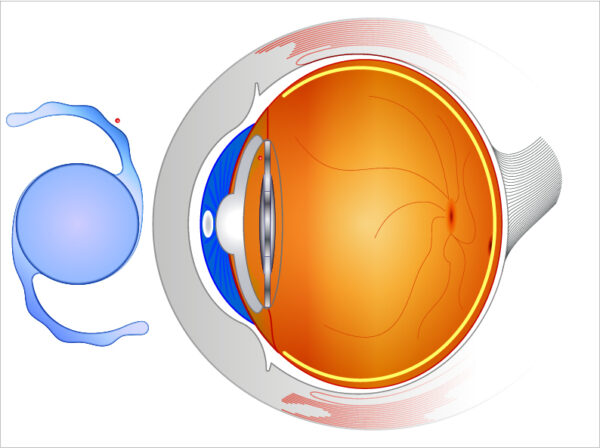 Diagram of toric lens
